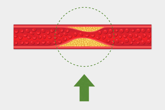 콜레스테롤이 쌓여 좁아진 혈관